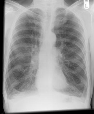 Lung Disease Prediction with RadGraph and CNNs